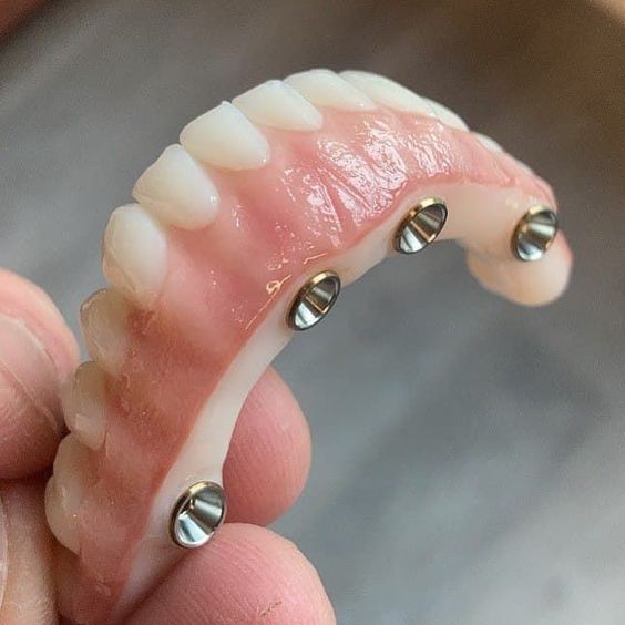 Mazatlan Snap on Denture
