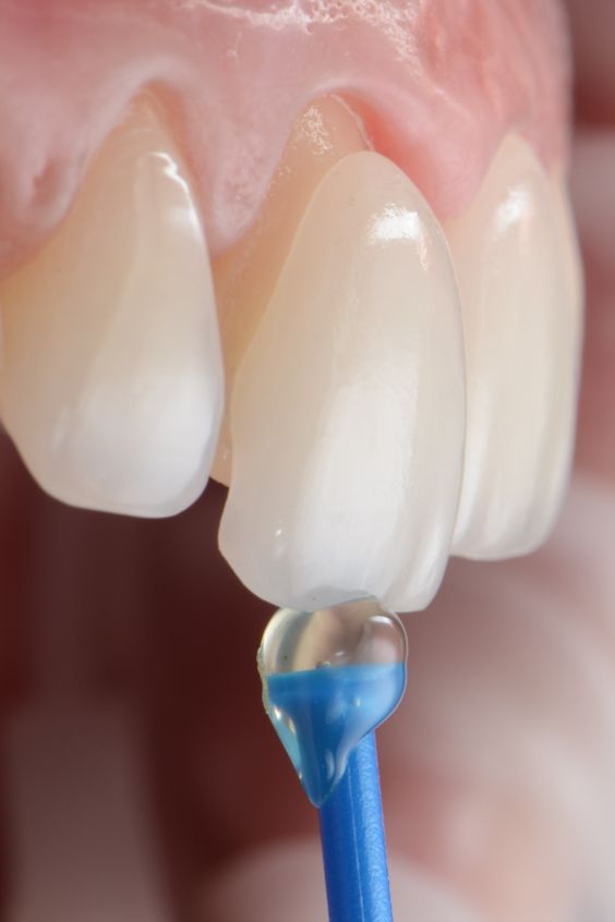 Dental Veneers in Mazatlan Sinaloa