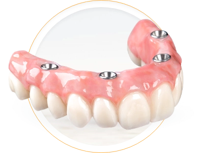 Dental implants in Mazatlan