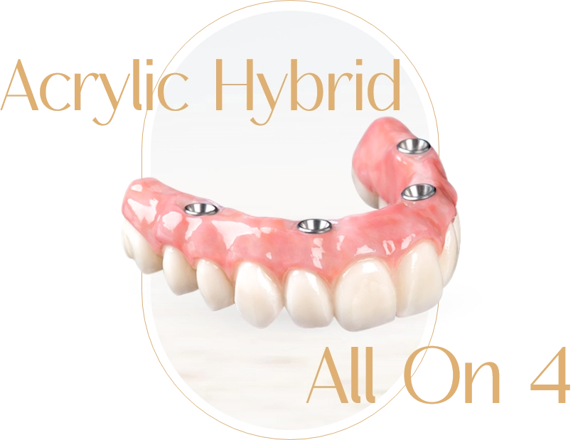 All on 4 Dental Implants Mazatlan