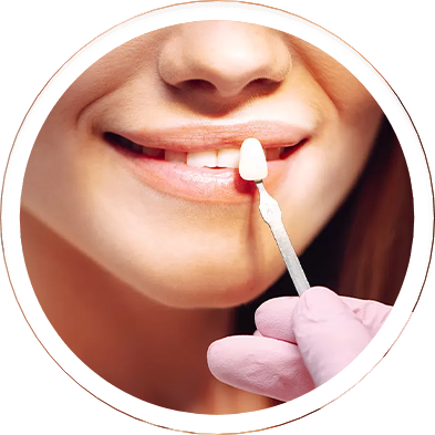 Mazatlan Dental Veneers