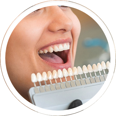 Dental Veneers in Mazatlan